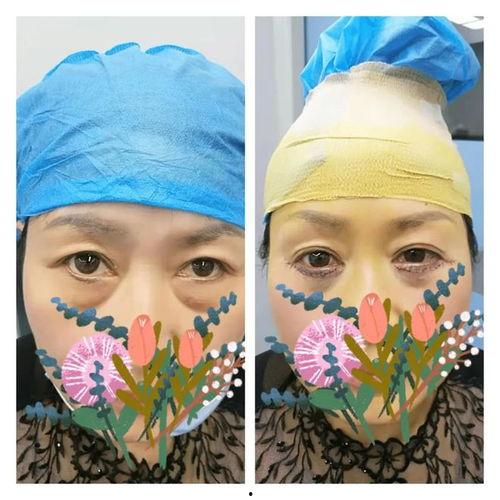 祛眼袋视频,祛眼袋视频全解析